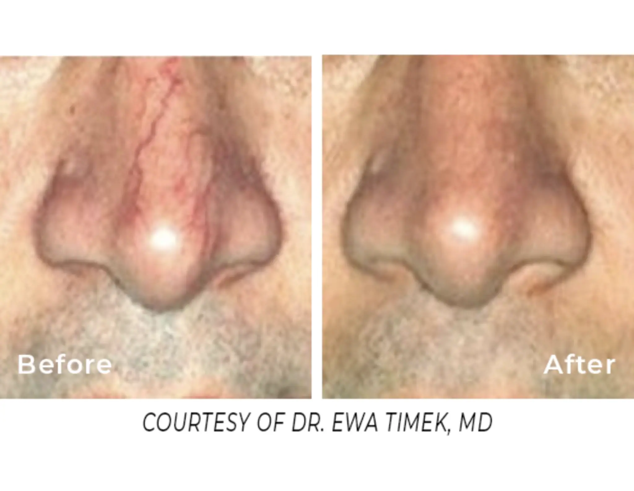 Spectrum Laser-Before-after2_1